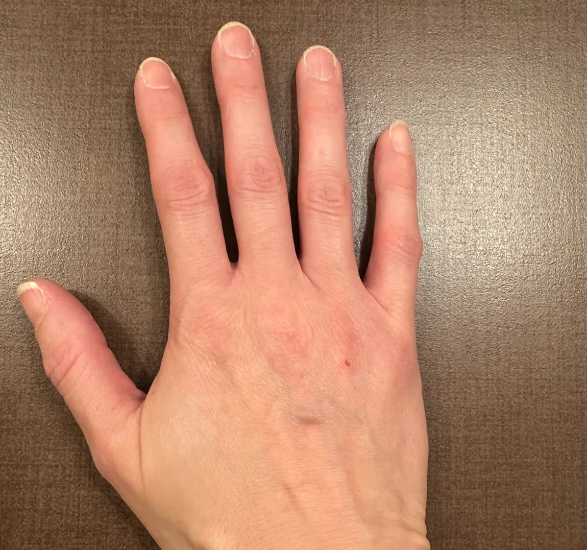 The same hand after the following 14 days of MEND+: noticeably less redness and cracking